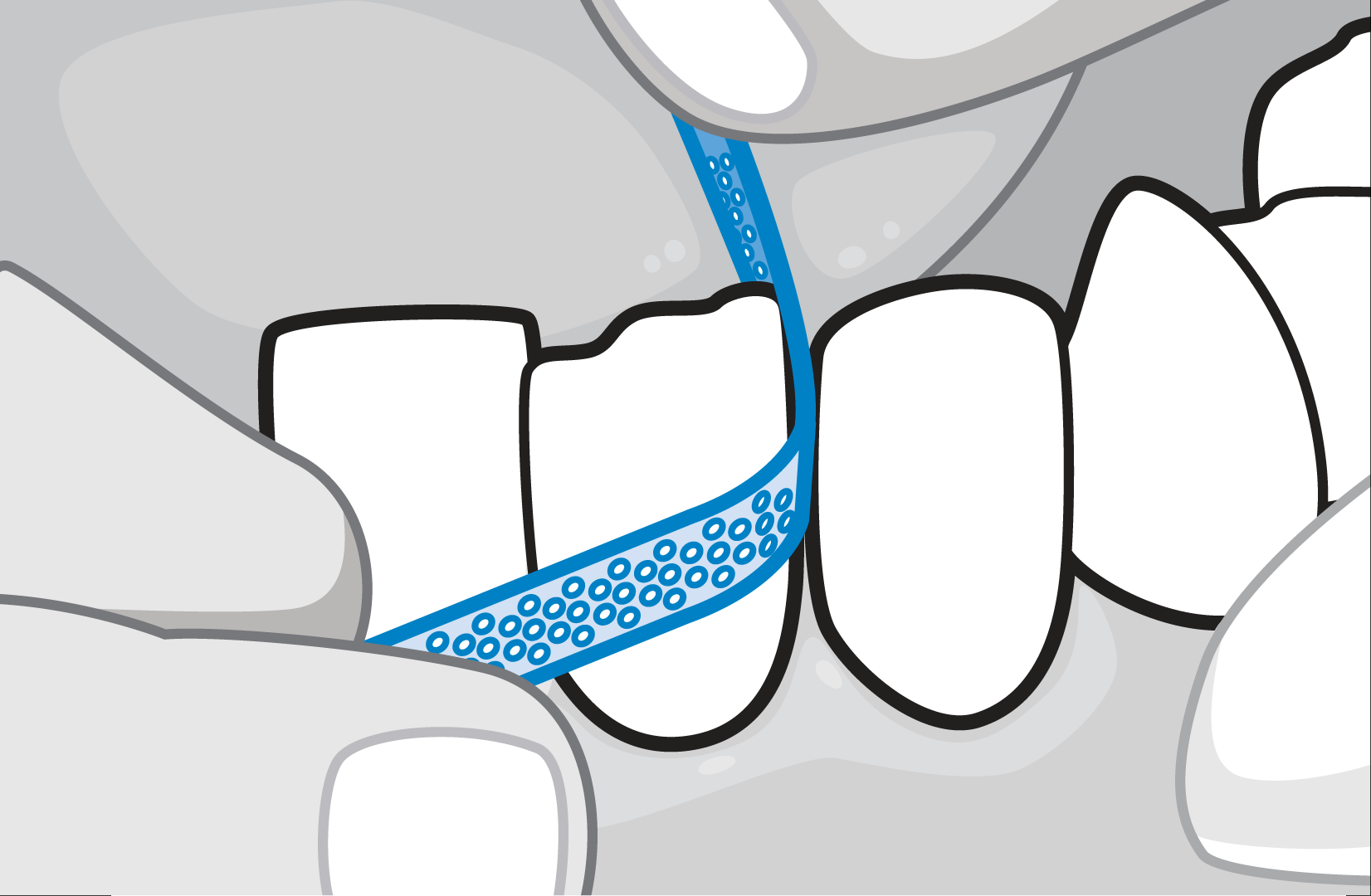 Facts About Interproximal Reduction (IPR) From the Sacramento Dentistry