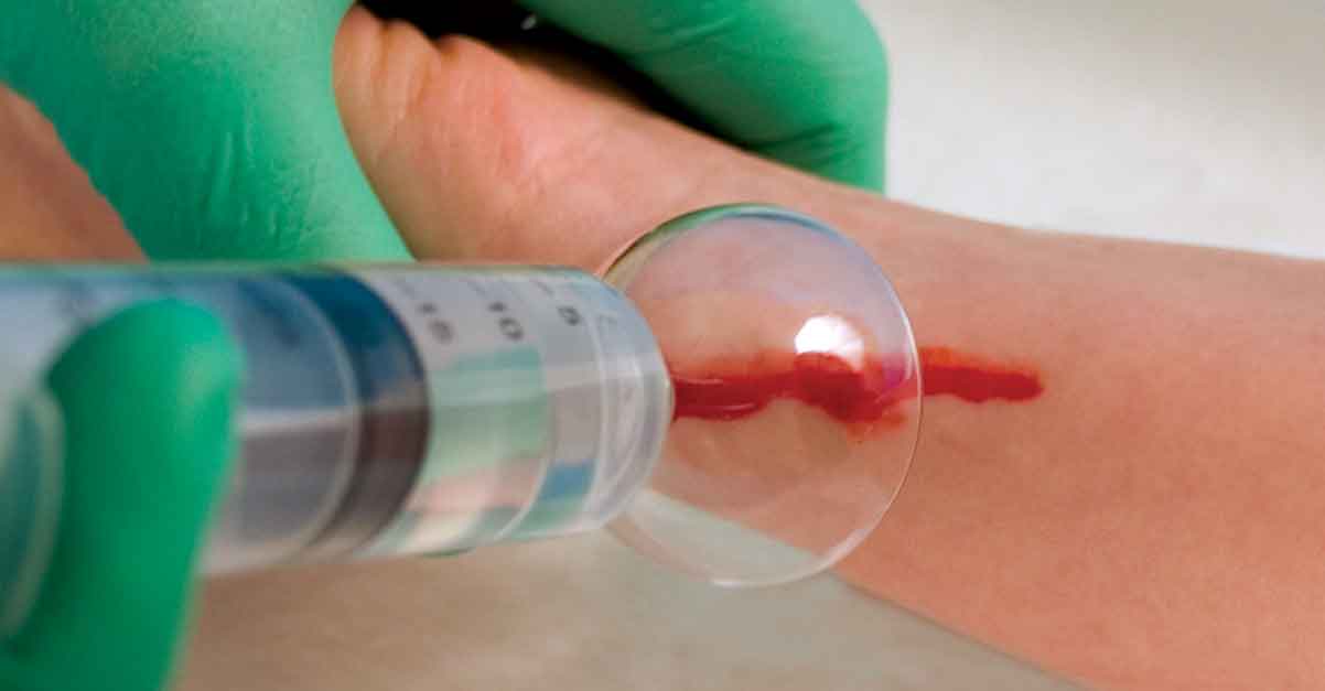 Are irrigation splash guards contributing to wound contamination? Company Newsroom of