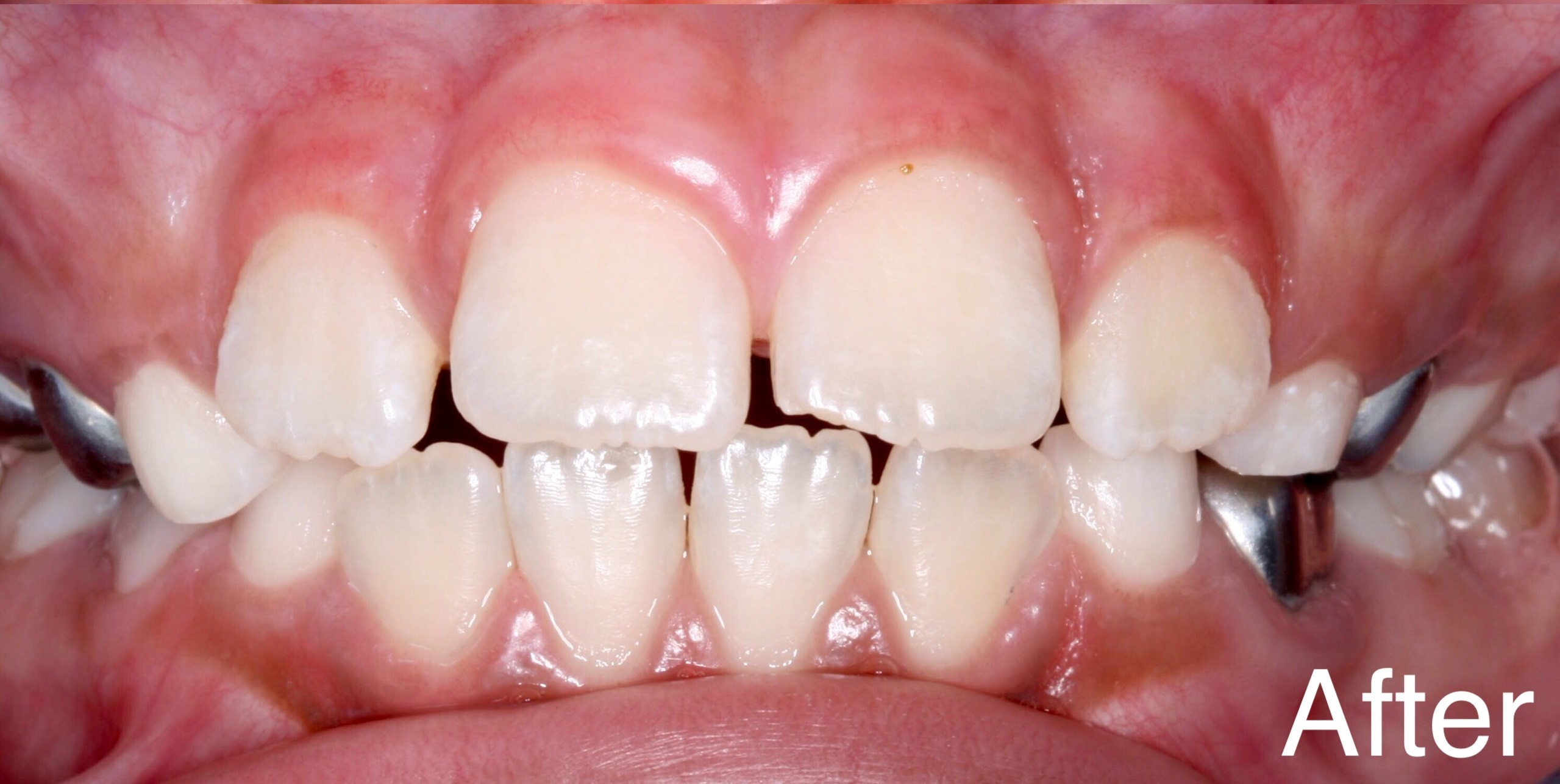 What do dark colored gums mean The Meaning Of Color